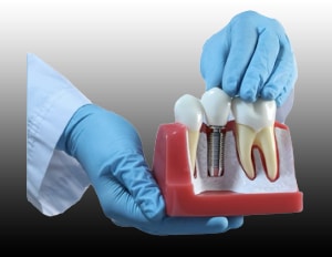 Multiple Dental Implants